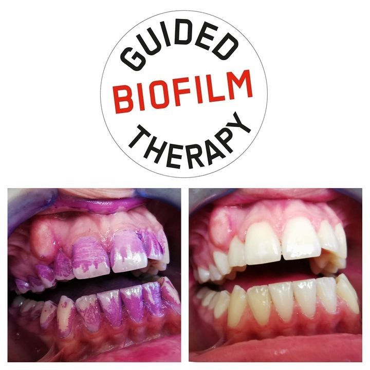 Guided biofilm therapy pred a po